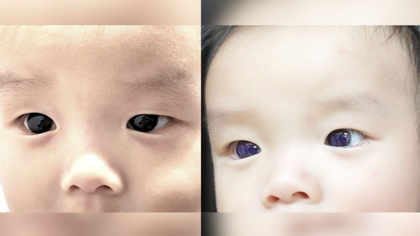 ⚕️ Medicina: Un antiviral volvió índigo los ojos de un bebé