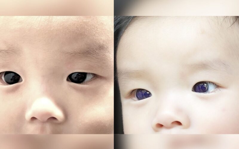 ⚕️ Medicina: Un antiviral volvió índigo los ojos de un bebé