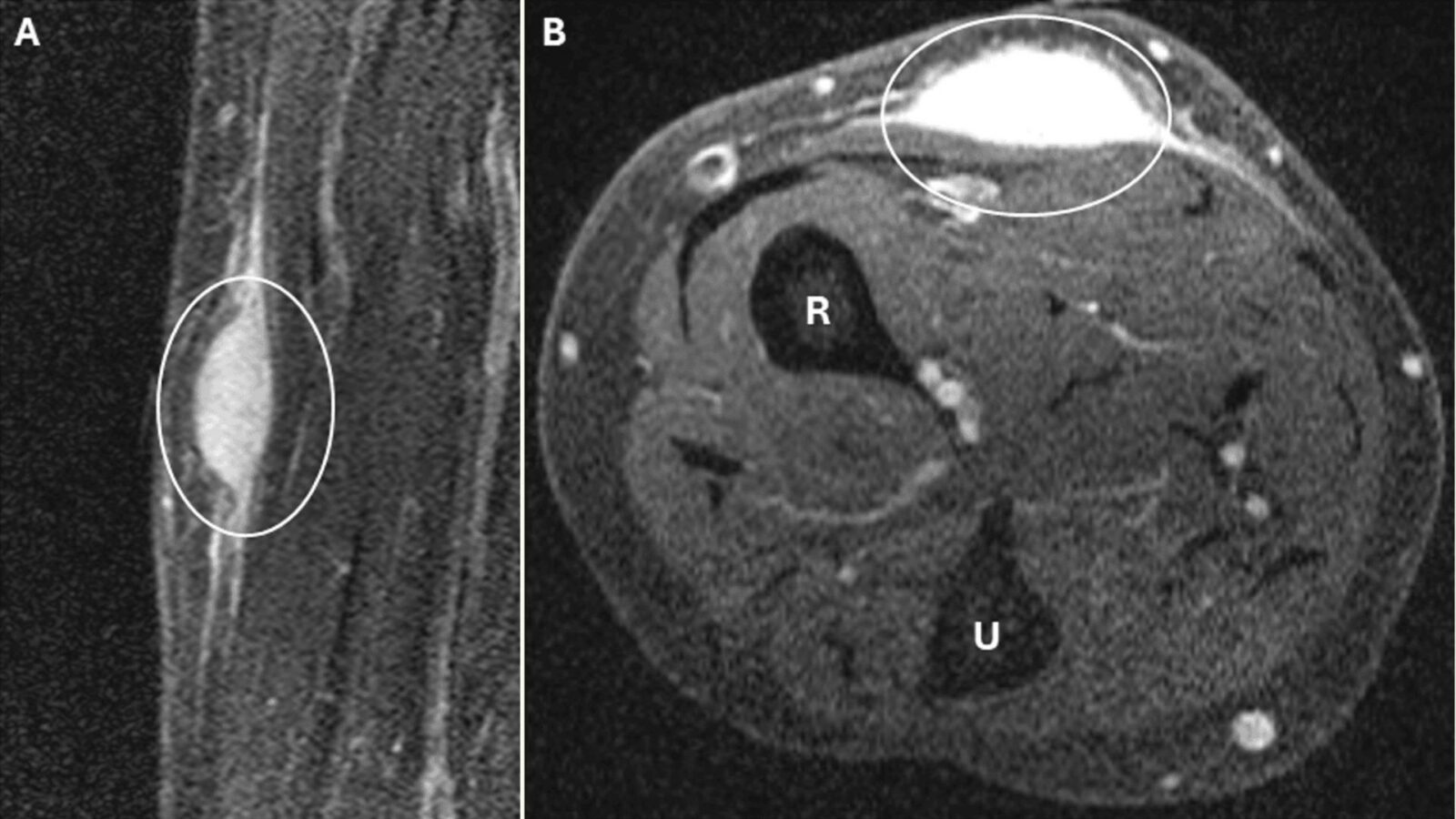 ⚕️ Medicina: Un tumor desaparece tras una biopsia