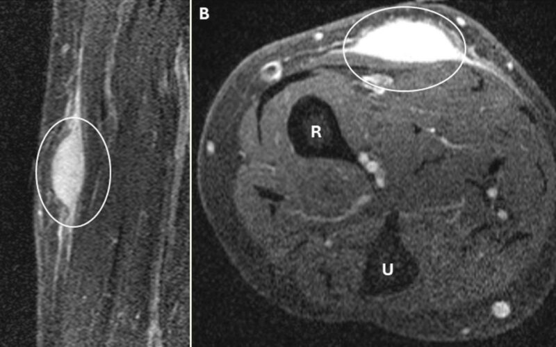 ⚕️ Medicina: Un tumor desaparece tras una biopsia
