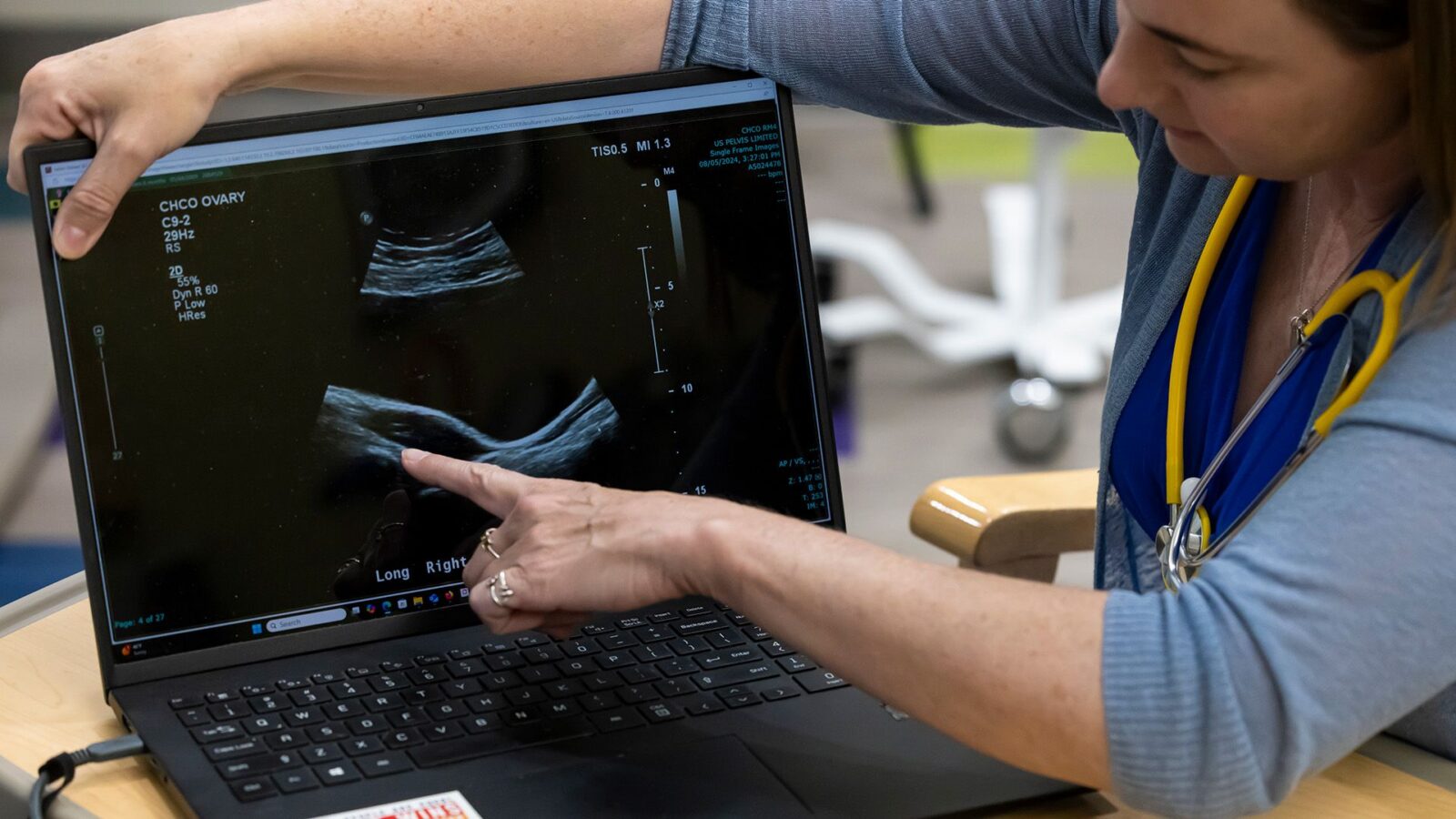 Salud: el PCOS pasa a llamarse PMOS
