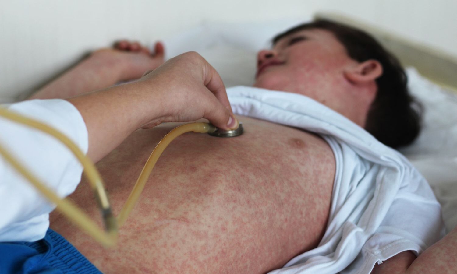 Salud: EE. UU. podría perder el control del sarampión