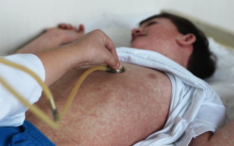 Salud: EE. UU. podría perder el control del sarampión
