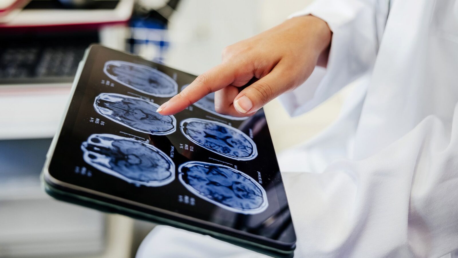 Medicina: «Brain freeze» farmacológico tras un ictus