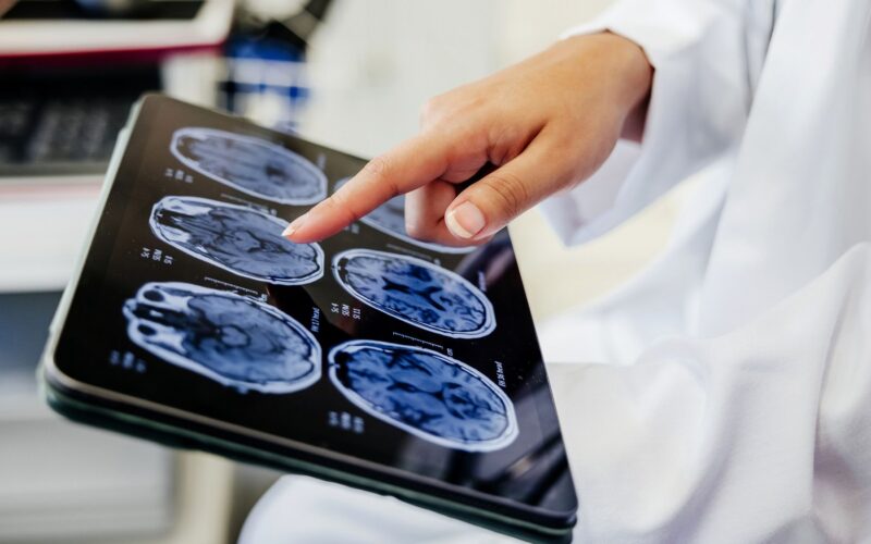 Medicina: «Brain freeze» farmacológico tras un ictus