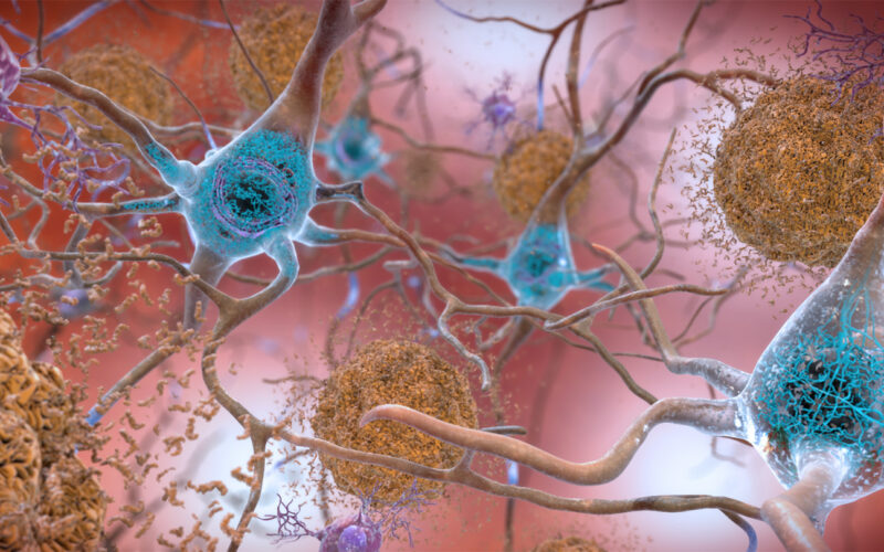 Medicina: Un fármaco contra tau muestra señales en Alzheimer