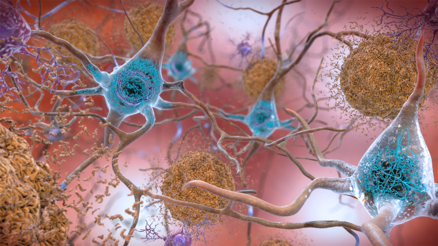 Medicina: Un fármaco contra tau muestra señales en Alzheimer