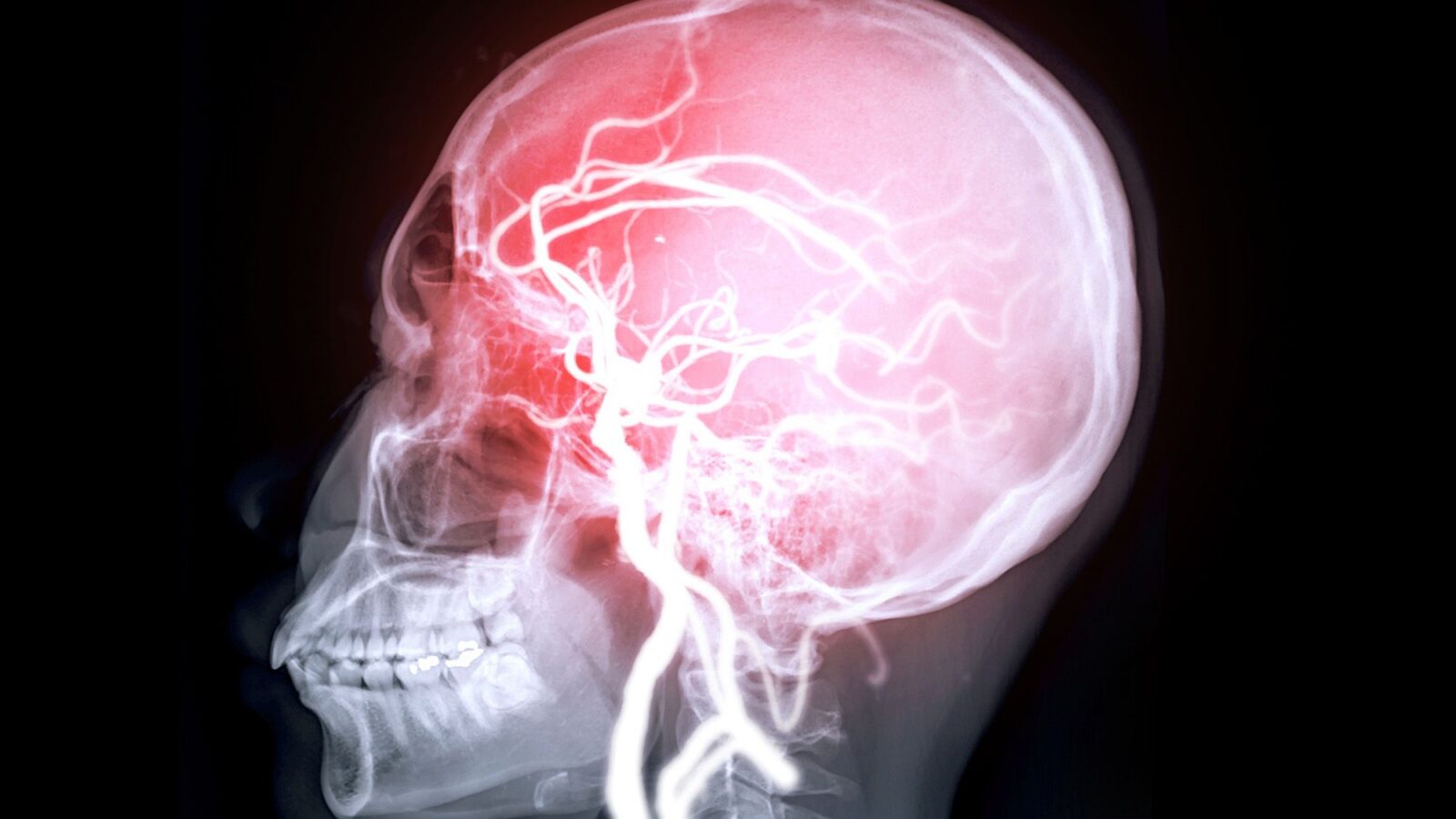 Neuro: El corazón débil deja huellas en la memoria