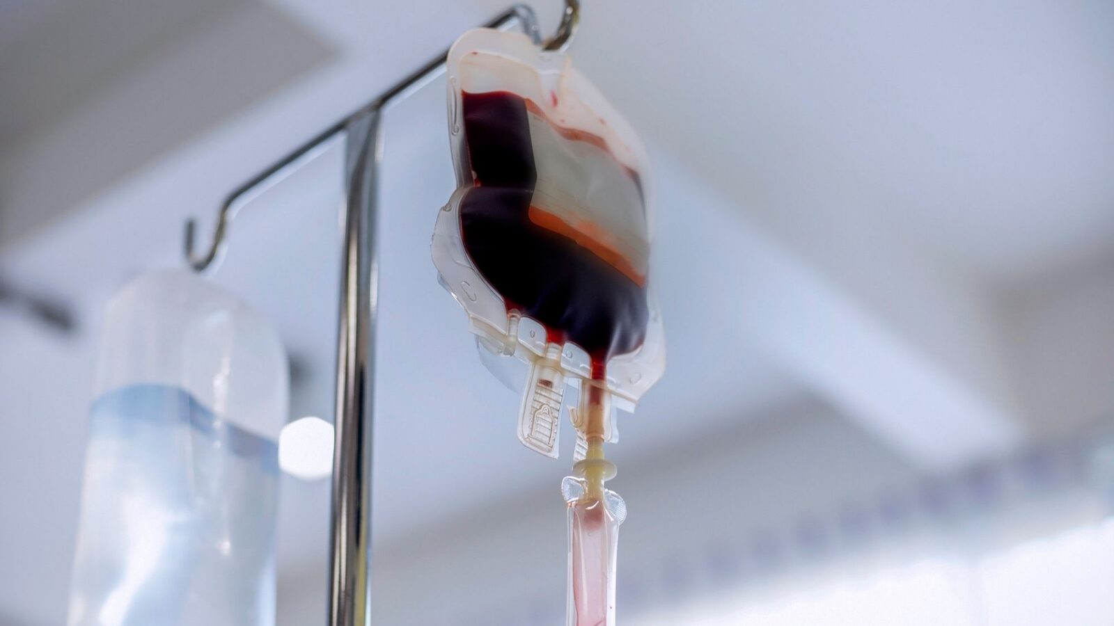 Medicina: Anafilaxia tras transfusión por alergeno alimentario