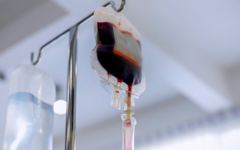 Medicina: Anafilaxia tras transfusión por alergeno alimentario
