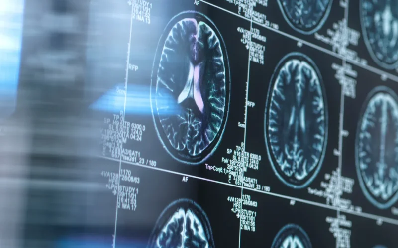 Neuro: La corteza cambia antes de detectar beta amiloide