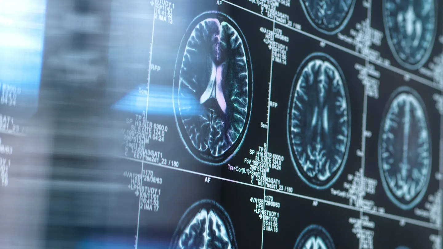 Neuro: La corteza cambia antes de detectar beta amiloide