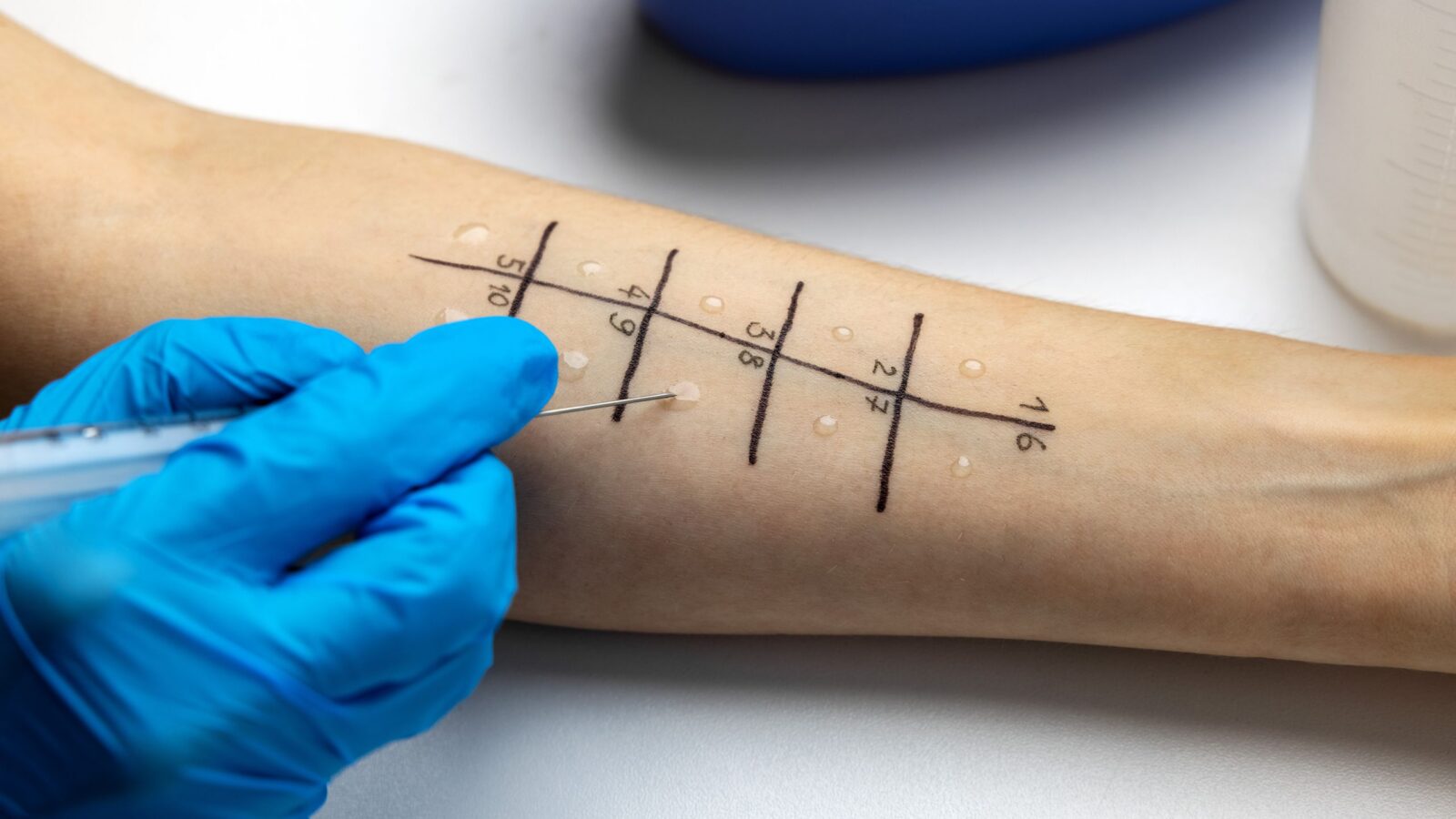 Medicina: Una alergia temporal tras un trasplante