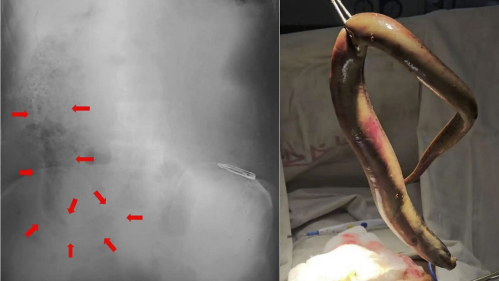 Salud: Una anguila perforó el colon de un pescador
