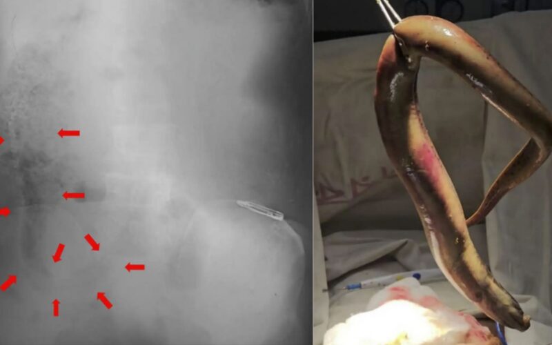 Salud: Una anguila perforó el colon de un pescador