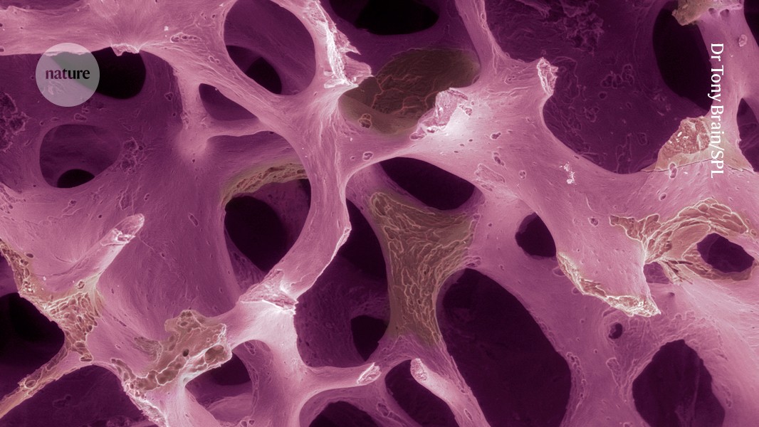 Salud: células modificadas frenan las fracturas en osteoporosis