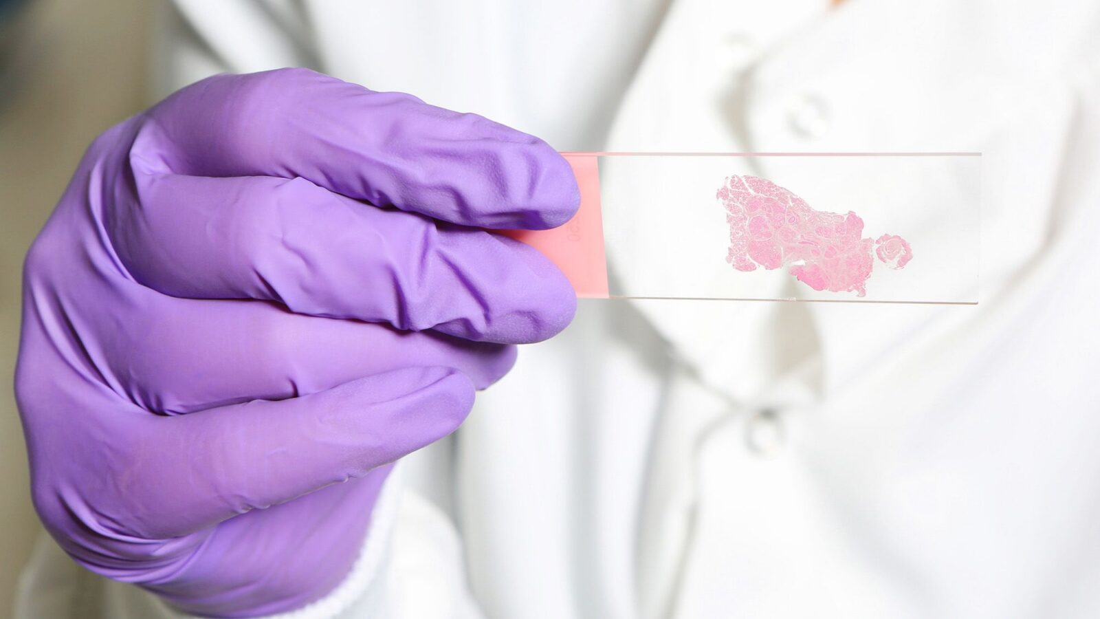 IA: Aprenden de patólogos para buscar señales de cáncer