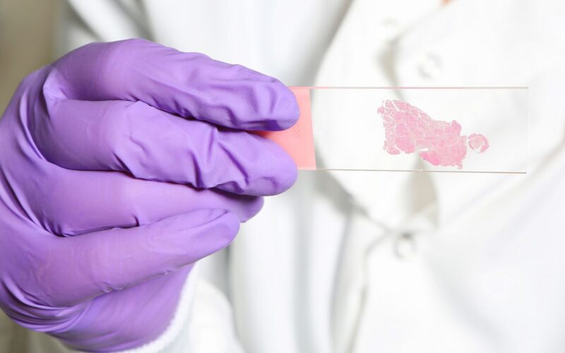 IA: Aprenden de patólogos para buscar señales de cáncer