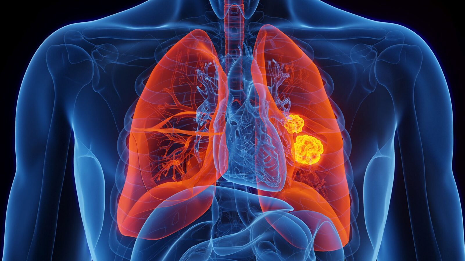 Genética: Vinculan una variante rara al cáncer sin tabaco