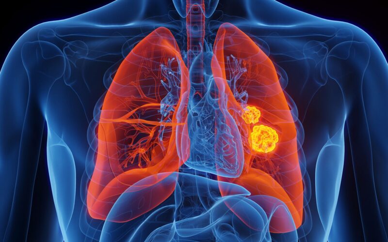 Genética: Vinculan una variante rara al cáncer sin tabaco