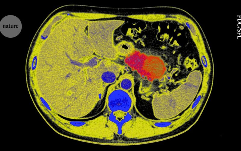 Salud: Tratar lesiones antes del cáncer de páncreas