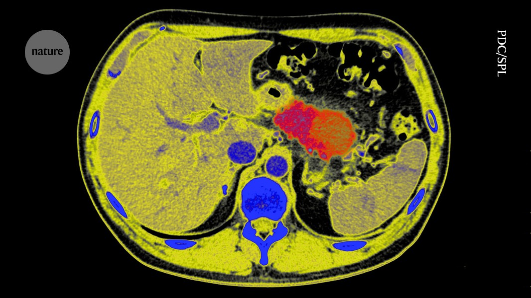 Salud: Tratar lesiones antes del cáncer de páncreas