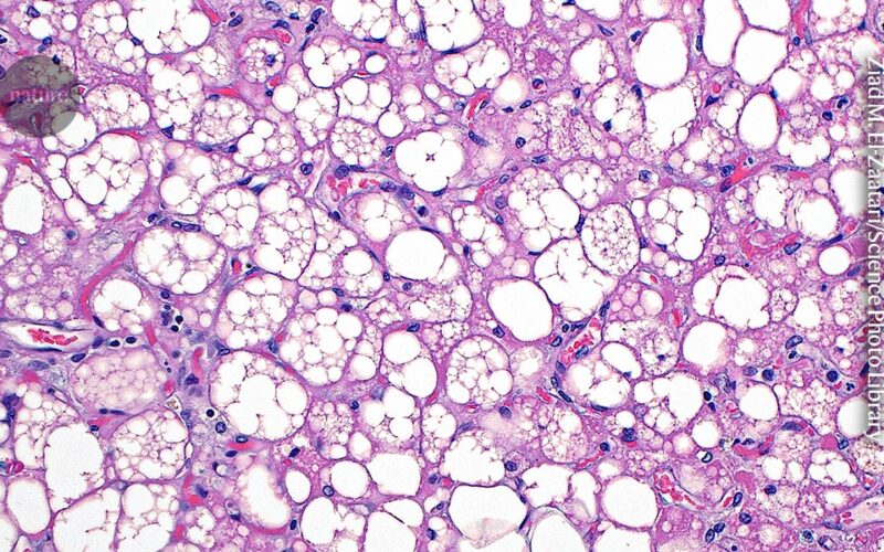 Salud: La grasa parda activa se asocia con menos enfermedades