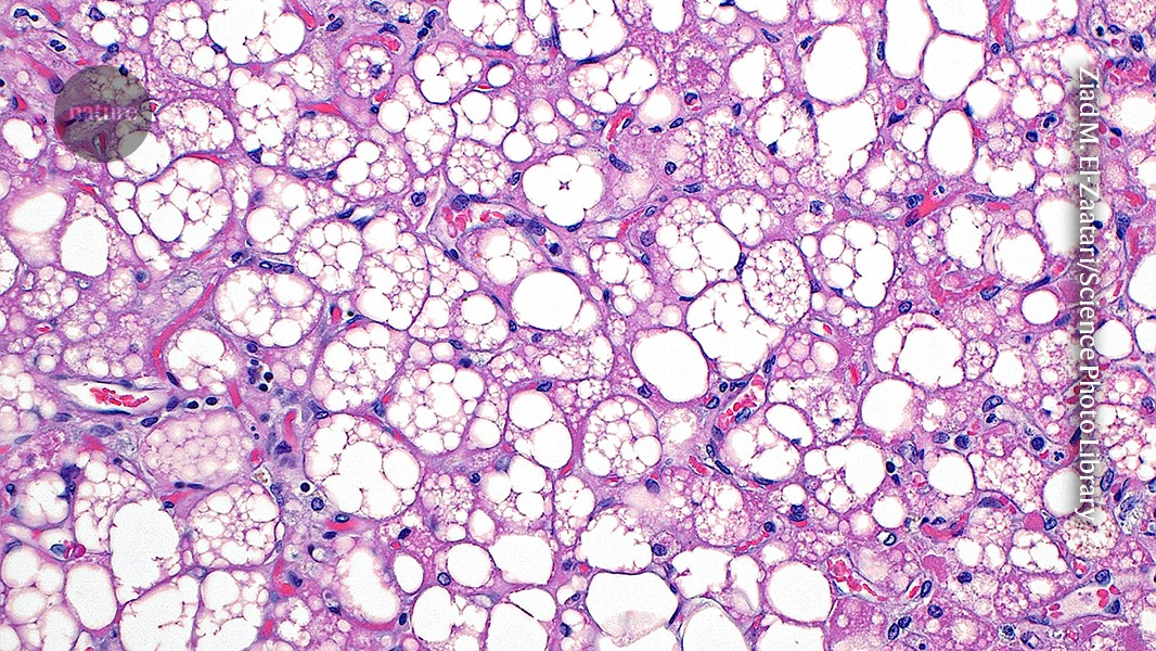 Salud: La grasa parda activa se asocia con menos enfermedades