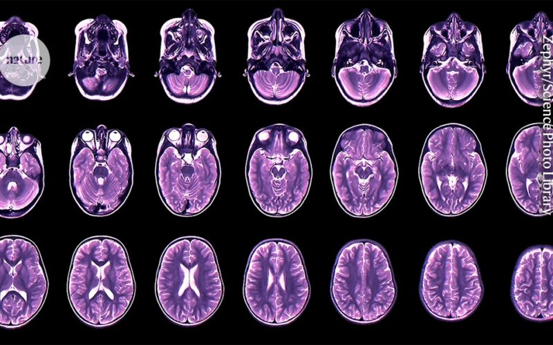 Neurociencia: El ritmo cerebral apunta al riesgo de síntomas