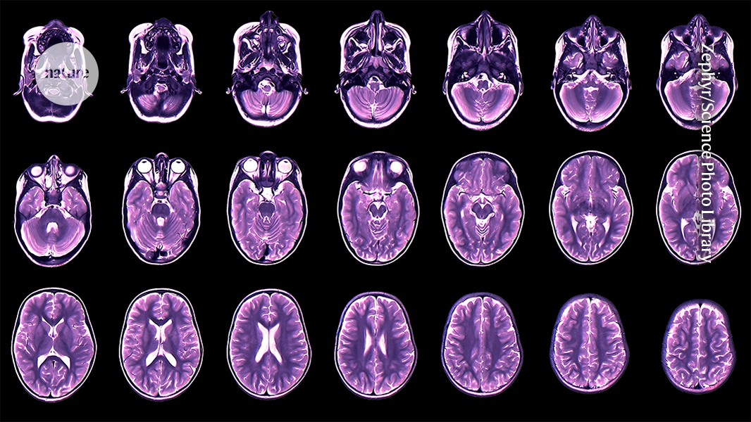 Neurociencia: El ritmo cerebral apunta al riesgo de síntomas