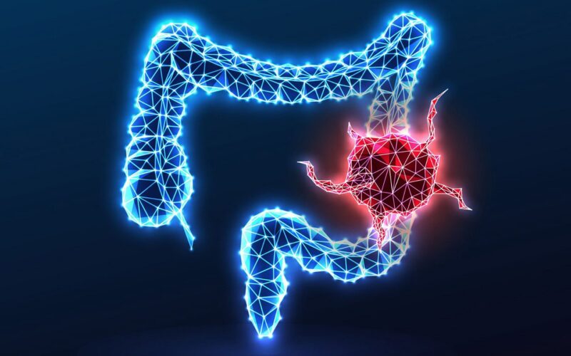 Salud: Pistas sobre el cáncer colorrectal en jóvenes